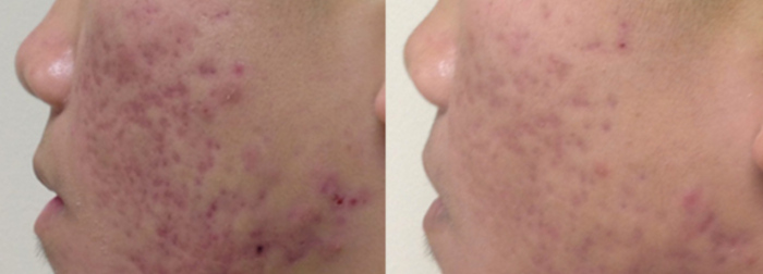 Acne scars laser treatment